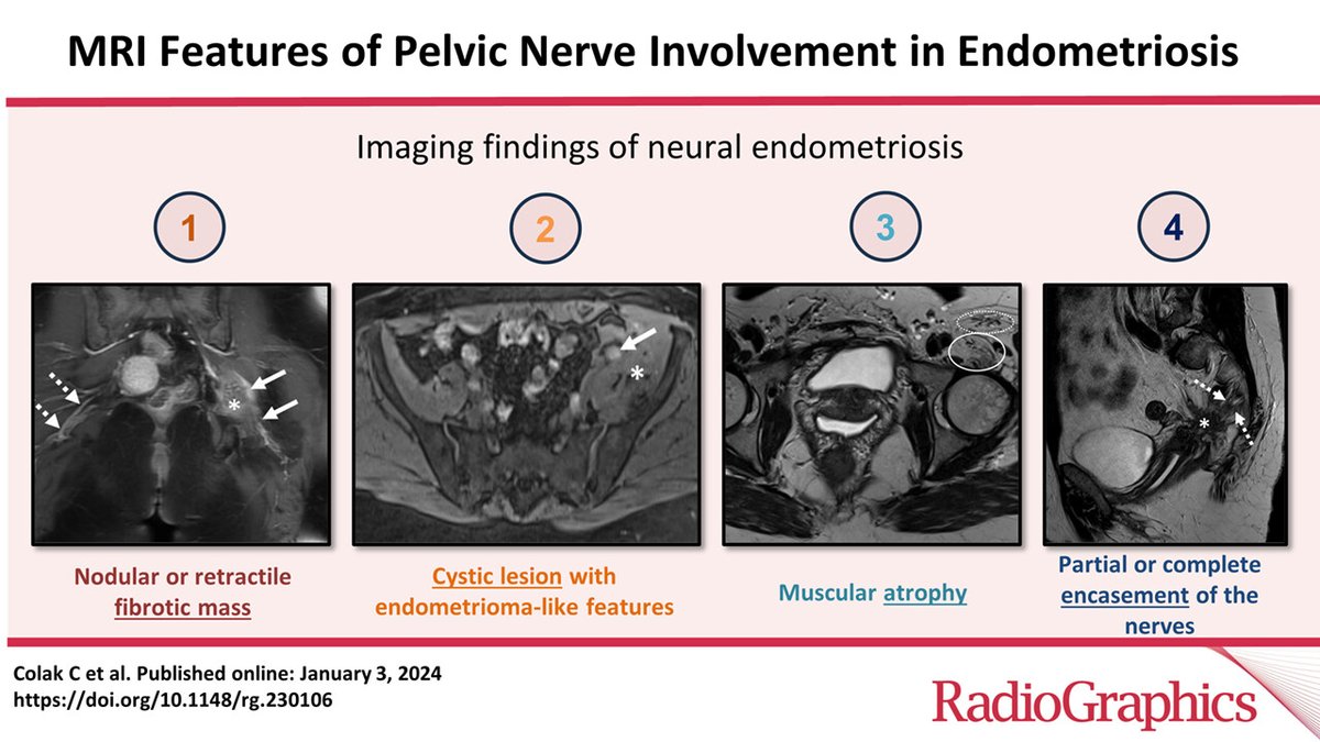 In endometriosis, pelvic nerves can become entrapped and early identification of neural involvement by radiologists is important to prevent irreversible nerve damage and neuropathy and optimize treatment plans. bit.ly/3TZjt6K @mayoclinic @clevelandclinic @ColakMD
