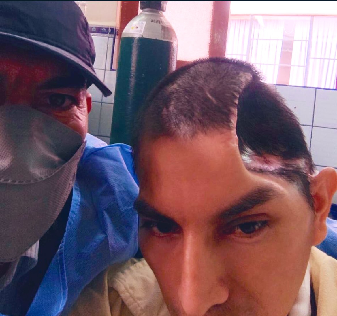 RuthLuqueIbarra's tweet photo. #HeridosDeDinaBoluarte #RolandoMarcas El 28 de enero de 2024, se cumplirá 1 año de violencia que este gobierno ejerció contra Rolando Marcas (37) (natural de Huancavelica). Desde enero 2023, él nunca más pudo trabajar. Su condición actual lo impide. Su pareja, Luz, también dejó de trabajar. Hace un tiempo difundí imágenes de Rolando que tenía un hueco en la cabeza producto del impacto que recibió. Han sido meses de larga espera, la anterior semana #RolandoMarcas por fin fue intervenido, y se le colocó una malla de titanio en el cráneo, para luego continuar con terapia y rehabilitación. 

Hoy será dado de alta. Actualmente vive alquilado en un cuarto por Manchay y debe permanecer en Lima, para continuar con un largo tratamiento. Rolando espera volver a caminar y trabajar para apoyar económicamente con sus 2 hijas. 

La entrega económica que el Gbno dio, para heridos como Rolando y su familia resultan ínfimos . #RolandoMarcas es uno de los #HeridosDeDina 

Todo apoyo es necesario. 

Cuenta en el BCP ahorros
Titular: Rolando Marcas
Cuenta: 19392341436076
CCI: 00219319234143607610
Yape 94253212 (Rolando Marcas)