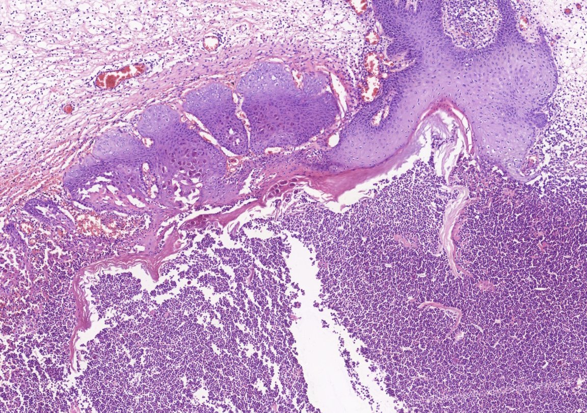 HLapsar's tweet image. More of PathClassics - polypoid lesion of anal canal, 24y F.
#PathTwitter #histology #infections