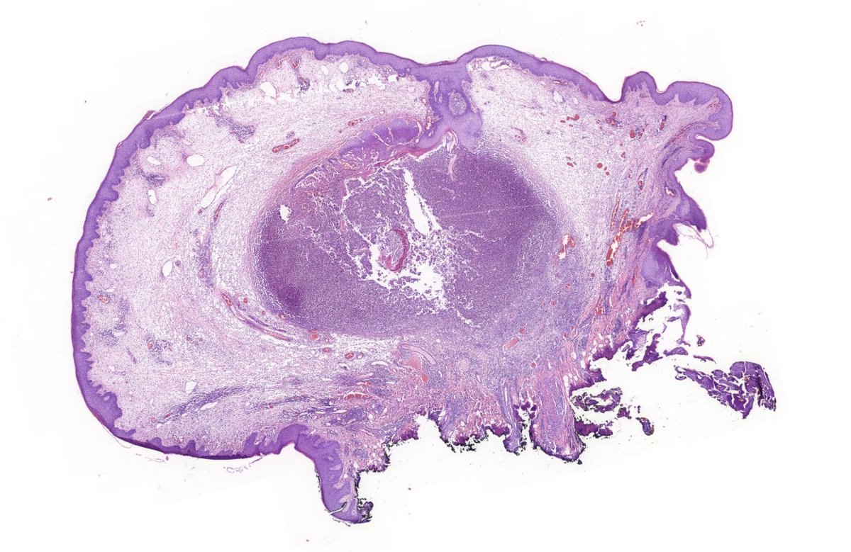 HLapsar's tweet image. More of PathClassics - polypoid lesion of anal canal, 24y F.
#PathTwitter #histology #infections
