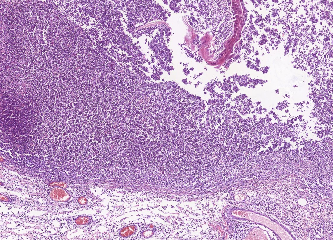 HLapsar's tweet image. More of PathClassics - polypoid lesion of anal canal, 24y F.
#PathTwitter #histology #infections