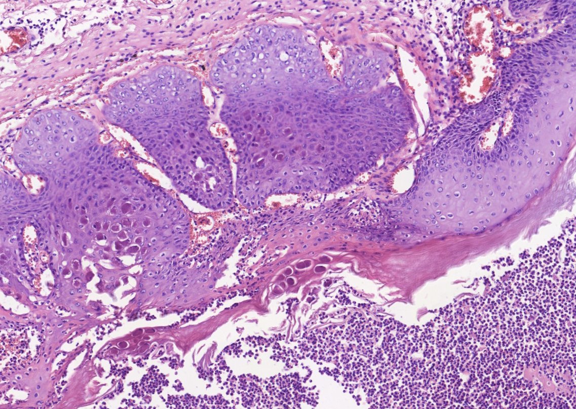 HLapsar's tweet image. More of PathClassics - polypoid lesion of anal canal, 24y F.
#PathTwitter #histology #infections