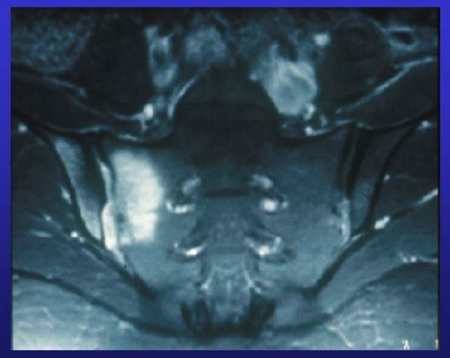 Rheumatologists and the Early Diagnosis of Spondyloarthritis SPACE study of adults referred to rheumatology with less than 2 years of chronic back pain (CBP), shows that only one-third can be reliably diagnosed with axial spondyloarthritis (axSpA). bit.ly/3Sv94yA.