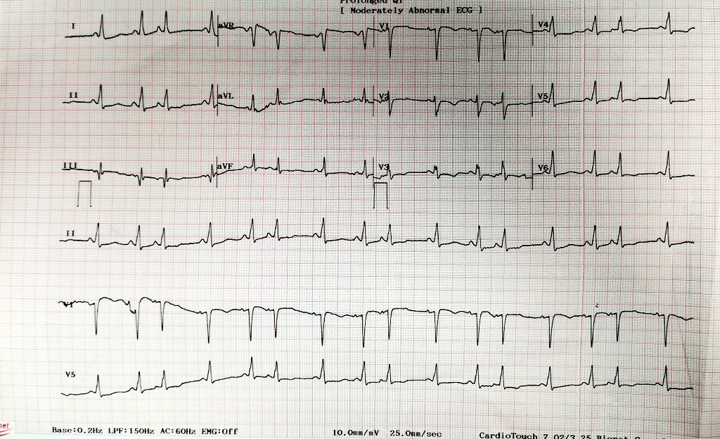 Madiha Fatima (@fatimamadiha) on Twitter photo 75 year old female, 3VCAD prior history of PCI to LAD, ICMP EF 30%, admitted with APE, rhythm changes intermittently from sinus to this, comment?
<a href="/GhazalaIrfan/">Ghazala Irfan, MBBS, FCPS (Card), FESC.</a> <a href="/HaseebR78219592/">Haseeb Raza</a> <a href="/ecgandrhythmRoe/">Dr. Andreas Roeschl</a> <a href="/Ecgloverr/">Pedram</a> 75 year old female, 3VCAD prior history of PCI to LAD, ICMP EF 30%, admitted with APE, rhythm changes intermittently from sinus to this, comment?
<a href="/GhazalaIrfan/">Ghazala Irfan, MBBS, FCPS (Card), FESC.</a> <a href="/HaseebR78219592/">Haseeb Raza</a> <a href="/ecgandrhythmRoe/">Dr. Andreas Roeschl</a> <a href="/Ecgloverr/">Pedram</a>