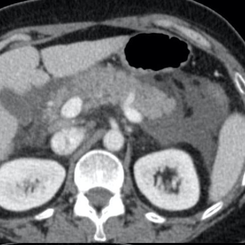 [1/3] 53-year-old female presenting with epigastric pain to the ED. Diagnosis? @BrighamRad @AURtweet @FOAMrad @SAR_RFS @futureradres @CBRadiologia #MedEd