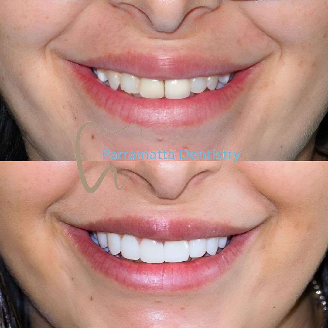 parramattadent's tweet photo. Elevate your dental game and show off your winning smile! 🤩

For bookings and/or more info:
🌐https://t.co/weo84Ko5zi
📞(02) 8090 1109

#ParramattaDentistry #MakingSmiles #TopDentist #BeautifulTeeth https://t.co/UoPmRb5ihR