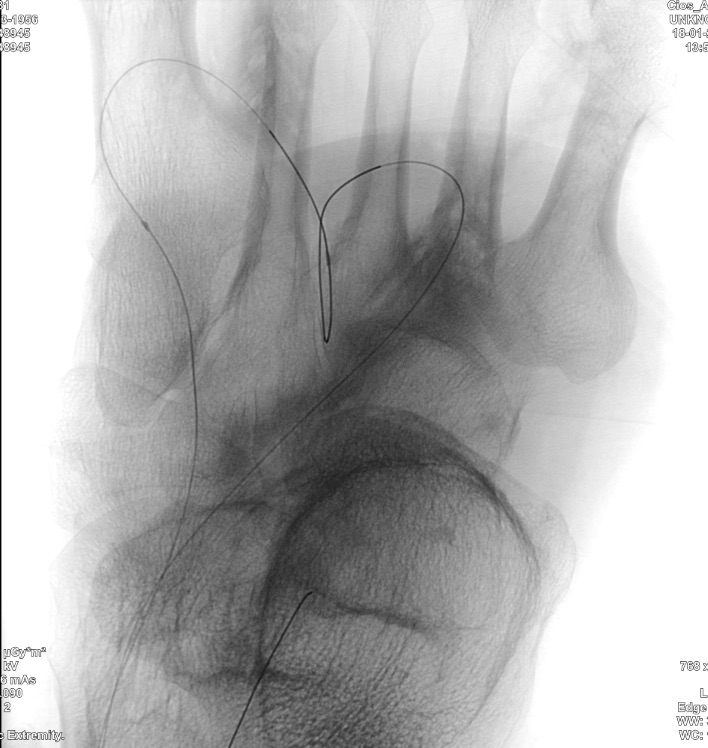 Valentine´s day? Where are these wires? Find the answer at FYA 2024 fya-congress.com #CLIfighters @Vascupedia_com @CLI_Global @_backtable