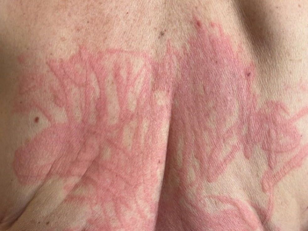 Did you know Urticaria, also known as hives, can also be triggered by emotional stress? 😲 Learn more about this skin condition here ➡️  buff.ly/47JeeLG