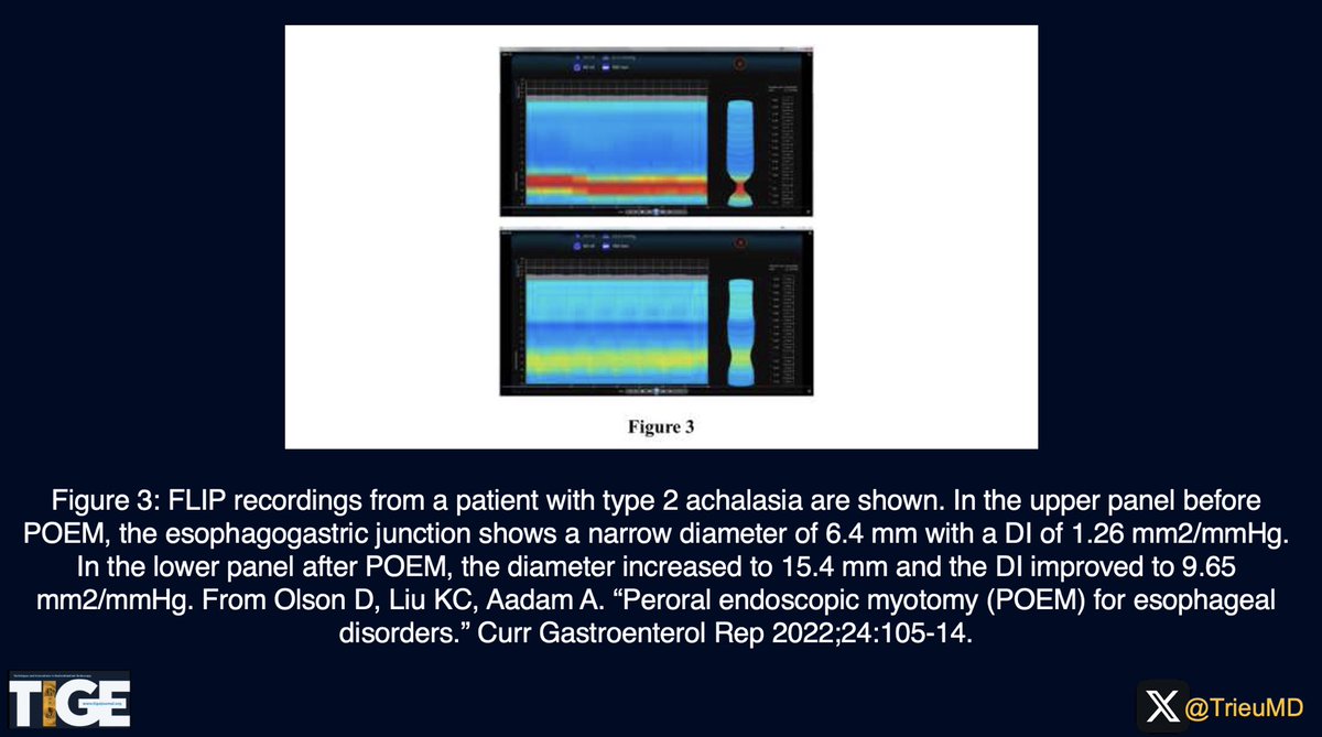 📣<a href="/AGA_TIGE/">TIGE</a> WEEKLY HIGHLIGHT📣

📑#DrGassanKassim &amp; #DrWilliamHasler review FLIP in E-POEM, G-POEM, &amp; Z-POEM, including methods, pre/post numbers in predicting response, &amp; pros/cons of FLIP.

🔎For more details: doi.org/10.1016/j.tige…

❓How often do you use FLIP??