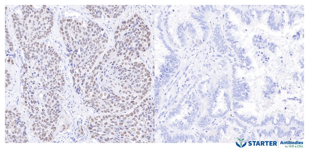 Starterbio's tweet photo. #IHC #antibody #P63
p63 Recombinant Rabbit mAb (SDT-054-38)
Catalog Number: S0B2049
Location: Nucleus
Application: IHC-P, WB

Find more: https://t.co/MXpyAse00S
#biotech #lifescience #CDx #IVD #cancer #pathology #Immunohistochemistry https://t.co/sZXL8N8i7B