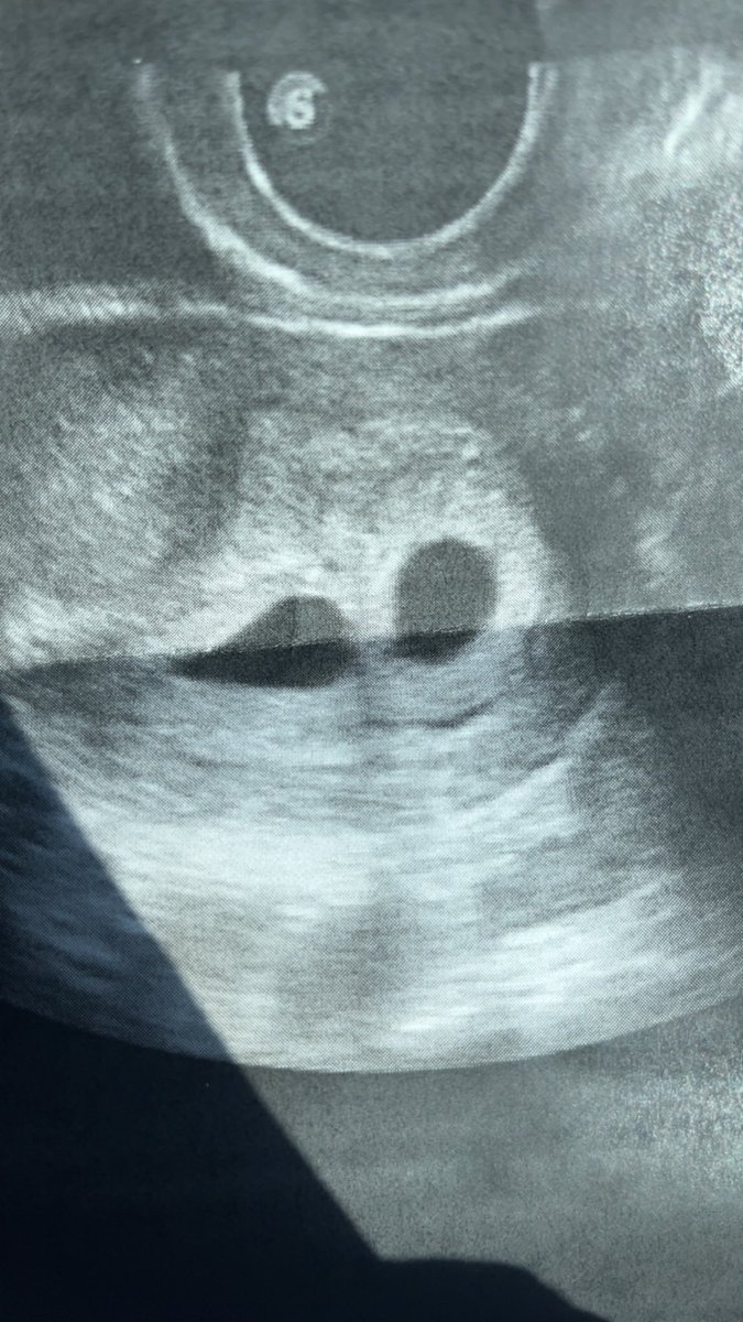 keeks_63's tweet photo. Forgot to tell twitter Im having having twins 🥹👯‍♀️ https://t.co/DJxukY0OEe