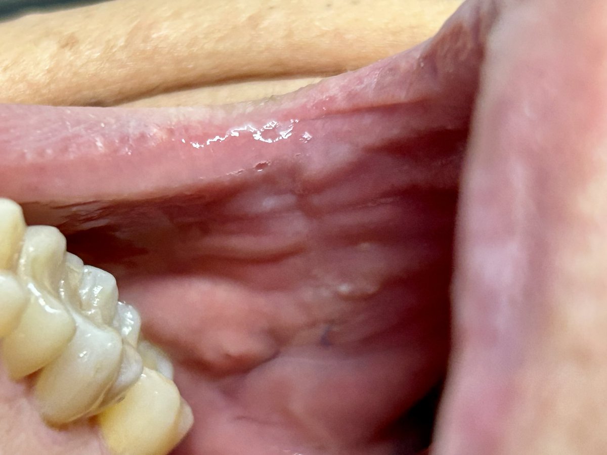 5 semanas post toma de injerto mucosa oral para plastia de uretra, apenas perceptible la cicatriz paciente sin complicaciones ni molestias.