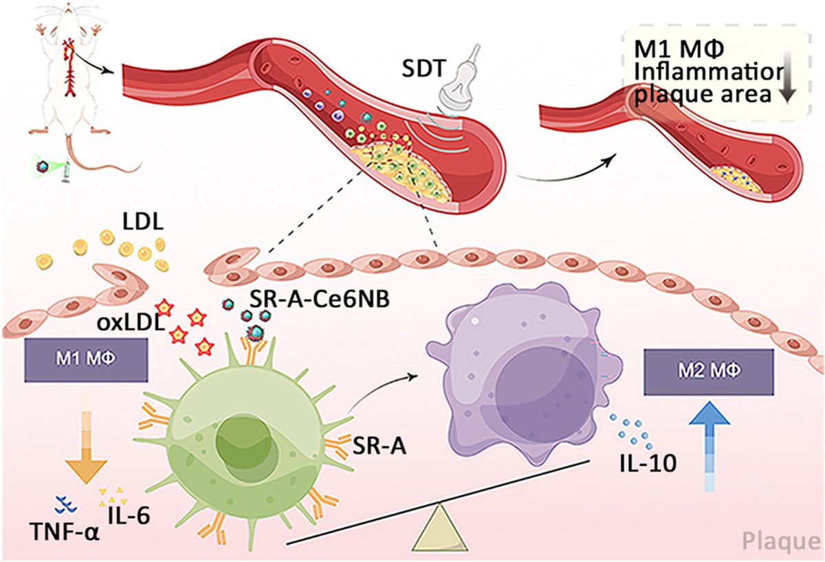 Macrophage-targeted ultrasound nanobubbles (SR-A-Ce6NB) exhibit favorable plaque-targeting by selectively recognizing SR-A
🔗atherosclerosis-journal.com/article/S0021-…
@society_eas @ELS_Cardiology #CvPrev #Ath