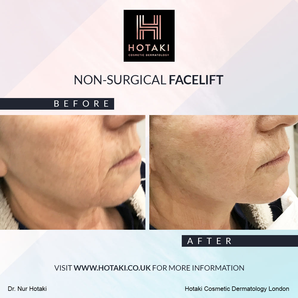 #DrHotaki #HotakiLondon #NonSurgicalAesthetics #AestheticTreatment #HotakiCosmeticDermatology #NonInvasive #NonSurgical #NonSurgicalFacelift #SkinRejuvenation