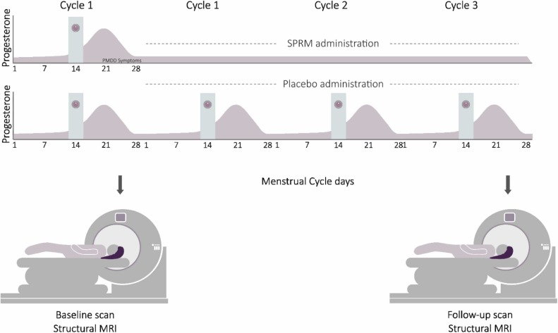 #BrandNew paper #ShortCommunication #OpenAccess White matter volume and treatment with selective progesterone receptor modulator in patients with premenstrual dysphoric disorder sciencedirect.com/science/articl…