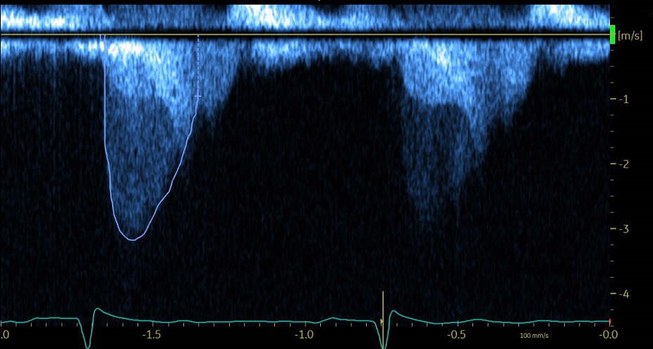 A patient with dyspnea. Spectral Doppler recording thru LVOT. What are the abnormalities? Difficult but solvable