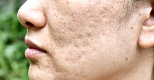 drgalen_org's tweet photo. Did you know that pockmarks, often caused by acne or infections, can leave lasting scars on the skin? Understanding the factors behind pockmarks and exploring effective treatments is key to achieving smoother, healthier skin. Read more here: https://t.co/4g6zZUJDpi
#Pockmarks #SkinCareTips