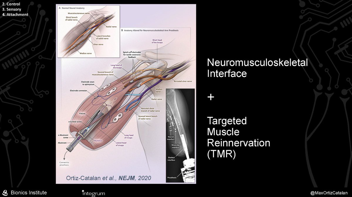 VvZiper's tweet image. It&apos;s @CoaptControl baby, that&apos;s how the bionic arm is born, such hands are made by our @endoprotezcentr, In order for this to become possible, we conducted an operation with the authorities according to the TMR protocol

#bionichand
#TMR
#osseointegration