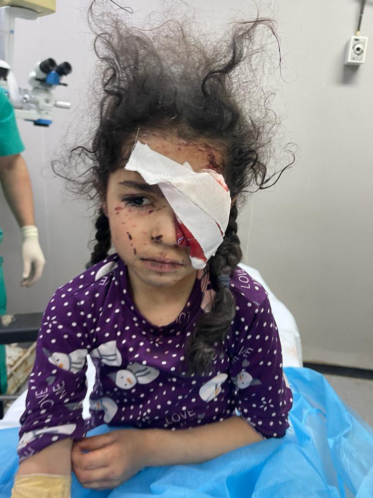 yakeyes's tweet photo. Aseel, a 6yo girl brought in after a bomb blast to her home with a large stone projectile implanted into her orbit. 

Pre-op she cries for her baba (father), but he didn’t make it. 

She’s covered in dust. Her hair is burnt. She lost her eye. 

This could’ve been my own daughter https://t.co/sd8Hzaibb8