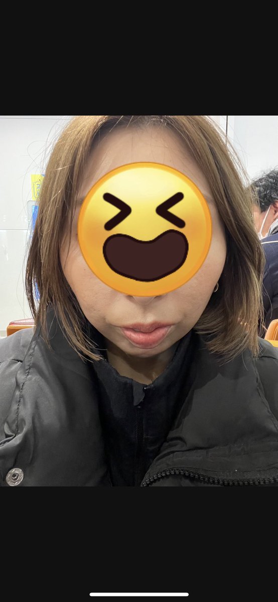 namin101's tweet photo. @BymePs さんでリジュランアイ、顎唇ほうれい線フィラー、インモードシュリンクやってきた🥹
2回目だったけど今回も丁寧ににしてもらいました☺️先生日本語で励ましてくれるしスタッフのみなさんも優しい☺️
またいこっと😊見苦しい写真ごめんなさい😂
1.2before 3以降施術後 https://t.co/LFX077LsRr
