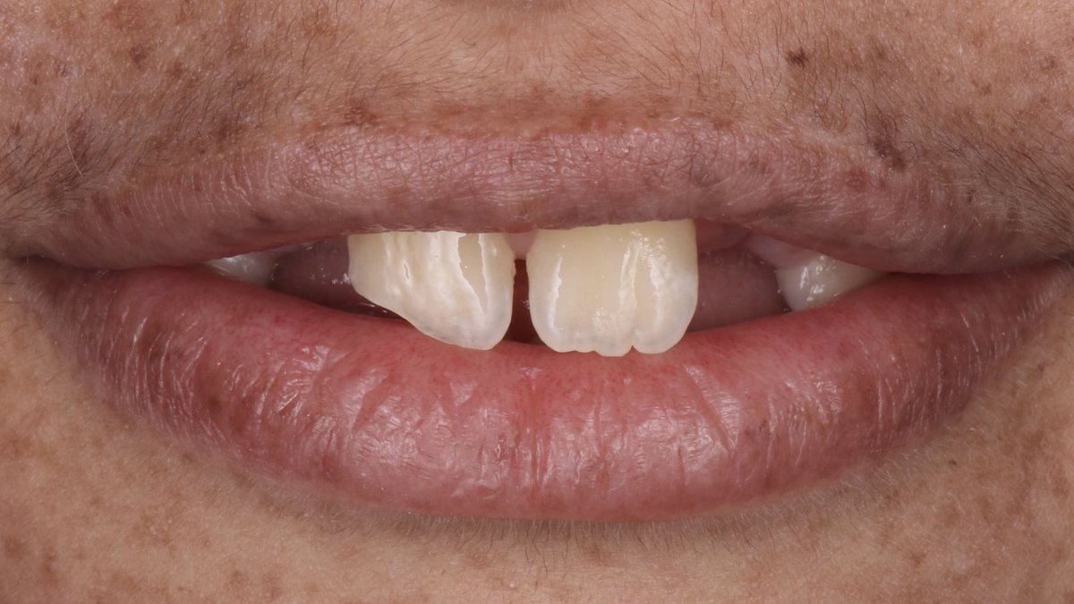 ghassanella's tweet image. ✨🪄

#ثنايا_ضاحكة_UQUDENT_SC