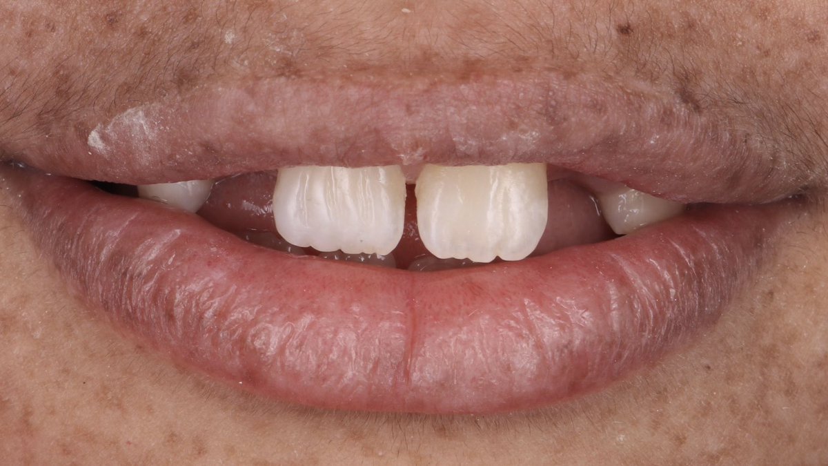 ghassanella's tweet image. ✨🪄

#ثنايا_ضاحكة_UQUDENT_SC