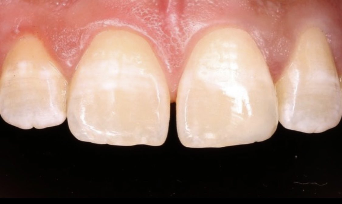 ghassanella's tweet image. ✨🪄

#ثنايا_ضاحكة_UQUDENT_SC