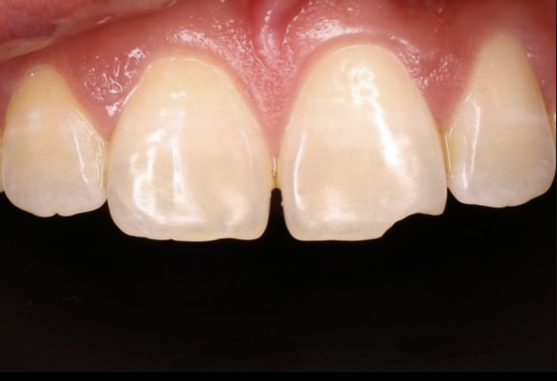 ghassanella's tweet image. ✨🪄

#ثنايا_ضاحكة_UQUDENT_SC