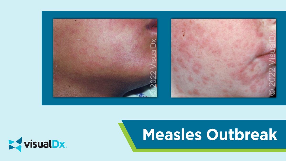 📢 Measles Outbreak Alert 📢 Health officials on high alert after outbreaks reported in Philadelphia and parts of Washington and New Jersey. This is a highly contagious disease with a rash developing about 14 days post exposure. To learn more, visit bit.ly/3OdrqkZ