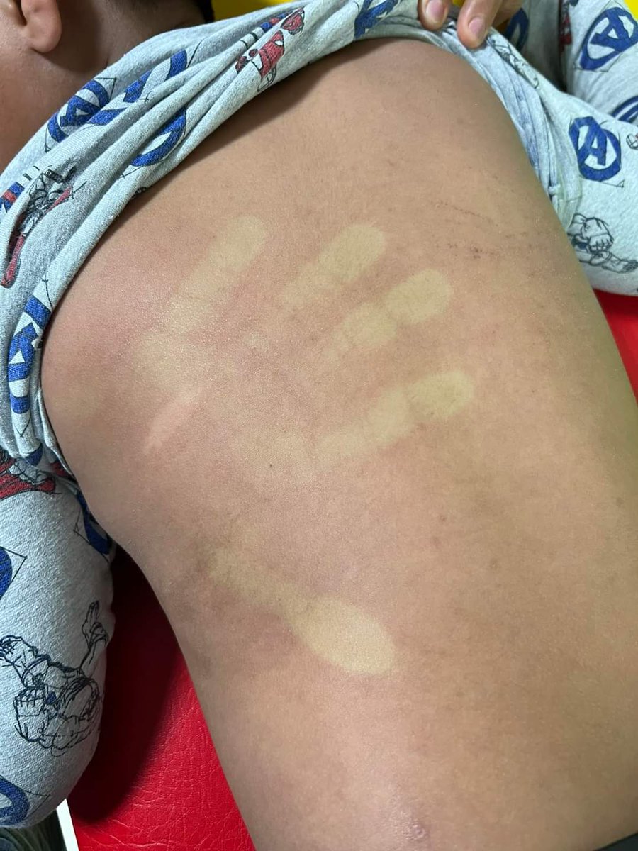 drrobertnunez's tweet photo. Niño de 10 años que inicia con fiebre hace 3 días, cefalea intensa (dolor de cabeza) dolor retro ocular, refiere dolor de garganta y dolor abdominal, náuseas y pobre apetito, lo llevan con el médico familiar de cabecera, el médico le maneja antibiótico pensando que es una infección bacteriana intensa, el paciente comienza al día siguiente con exantema (es esa coloración roja de la piel) los padres piensan que es una alergia al antibiótico. 

Lo que que el niño tiene es dengue (el dengue no tiene un tratamiento hasta el día hoy) ya hoy tiene 3 días de evolución (lo rojo apareció al 2do día) hoy amanece mejor, ya no tiene fiebre pero esta muy decaído y con pobre apetito, es normal y el apetito se recupera hasta los 5 o 7 días después de iniciado el cuadro. 

El dengue al inicio puede engañar hasta el más experimentado médico, por eso, es mejor esperar 48- 72 hs y solo manejar la fiebre con paracetamol (favor no automedicarlos), han operado niños pensando que es apendicitis y resulta que es liquido libre secundario al dengue, yo al dengue le llamo el gran simulador. 

Para los colegas médicos que me siguen: La forma del exantema en el dengue (lo rojo de la piel) es muy parecido, al que presenta el Zika o el chikungunya, pero es muy diferente al exantema de virus de la rósela o de la quinta enfermedad (exantema súbito) la diferencia solo expertos en estas infecciones puede hacerla, casi cualquier virus puede producir exantemas; por ejemplo en este niño que tiene dengue, fíjense cómo queda la palma de mi mano impresa por 3 segundos, en los otros exantemas no pasa eso.