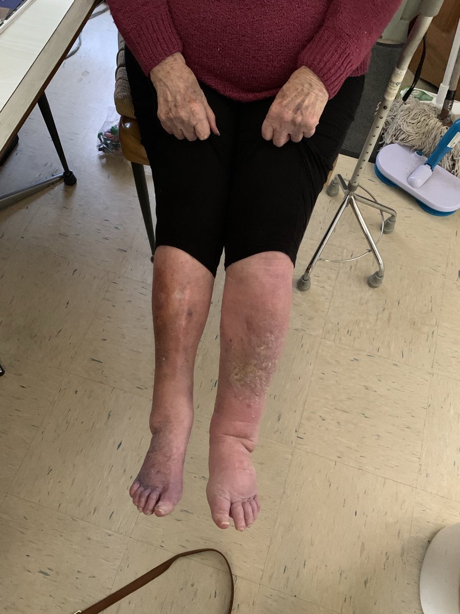 CLAN_AU's tweet photo. Meet Mavis turns 94ys on 26stJanuary #AustraliaDay 
In order to get a $10k hardship payment she must attend her Doctor to sign paperwork 
Premier ⁦@JacintaAllanMP⁩
she can’t walk to get her mail from letterbox #HamptonEast 
Please change #Redress policy
#SpringSt #badlegs https://t.co/GOW6gGoppT