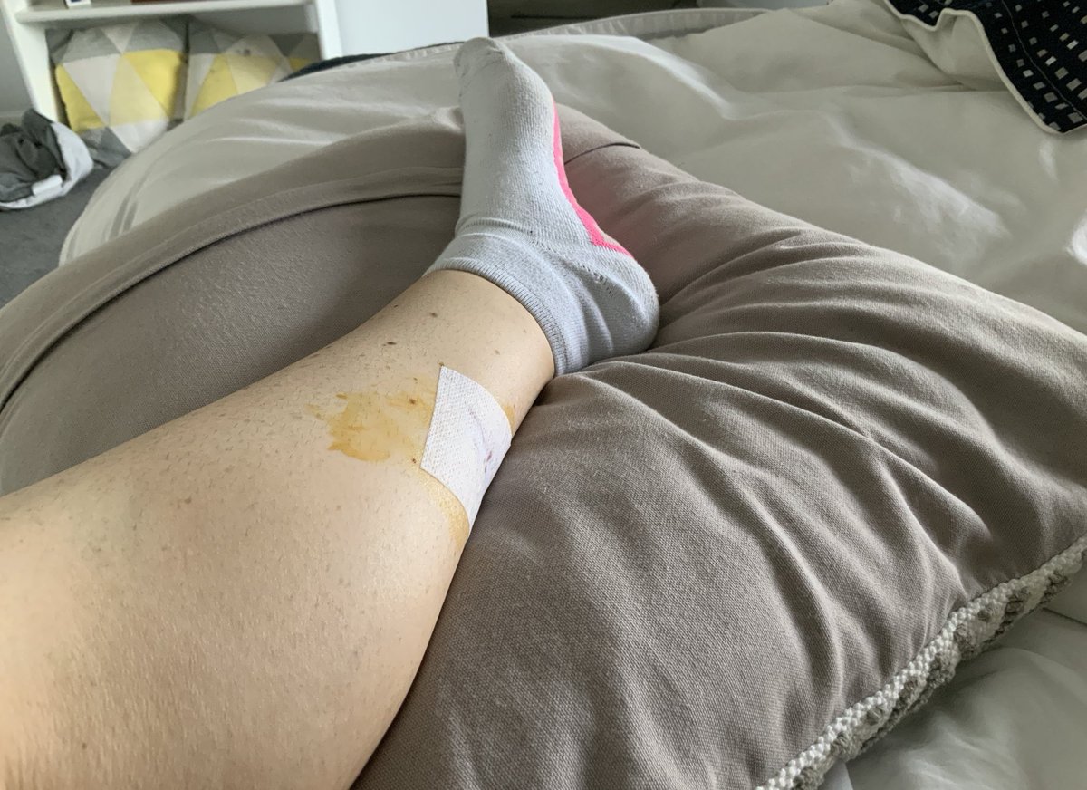 ParttimePleb's tweet image. When life thinks you haven’t had enough excitement. 🥺 Remember your skin checks peeps! 🤞