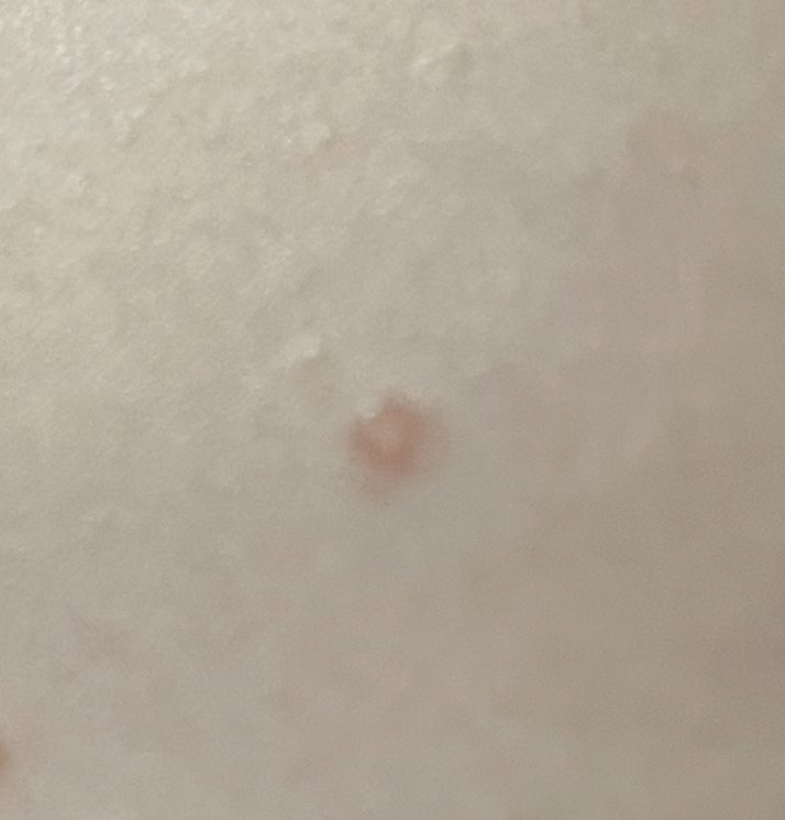 Dites, les gens qui savent, ça fait bouton de varicelle non ? 

J’ai appelé le doc mais pas de place avant 2 semaines donc en attendant si vous en avez déjà vu ?

Il en a un autre plus petit sur le doigt mais c’est tout

#doctoctoc