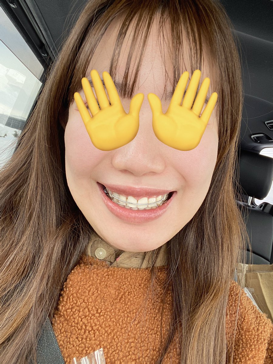 ワイヤータイプのリテーナー受け取ってきた🦷
基本はこっち使って、人前とか見た目が気になる時だけマウスピースを使ってと説明受けたけど、私もその使い方しようとしてたからよかった〜😌🌷