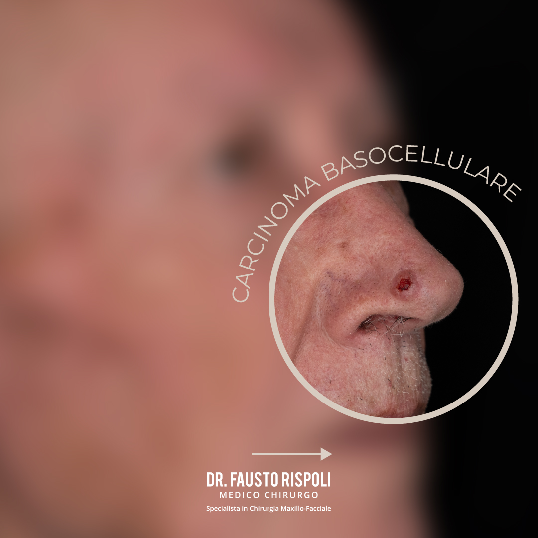 FaustoRispoli's tweet photo. Asportazione carcinoma basocellulare della punta nasale e ricostruzione con lembo bilobato.
Asportazione eseguita  secondo margini di sicurezza oncologica.
Per ulteriori informazioni, è possibile prenotare una consulenza specialistica:
MOLISE 📞 0875703758
SICILIA 📞 090902479 https://t.co/IbmEonIHZO