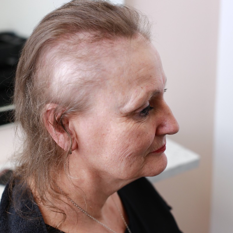 HairSolved's tweet photo. Female Pattern Baldness or Female Pattern Hair Loss typically presents itself as thinning at the crown of the head. Because it is caused by a number of genetic and hormonal factors, it also affects younger women. 

Part 2 of 2