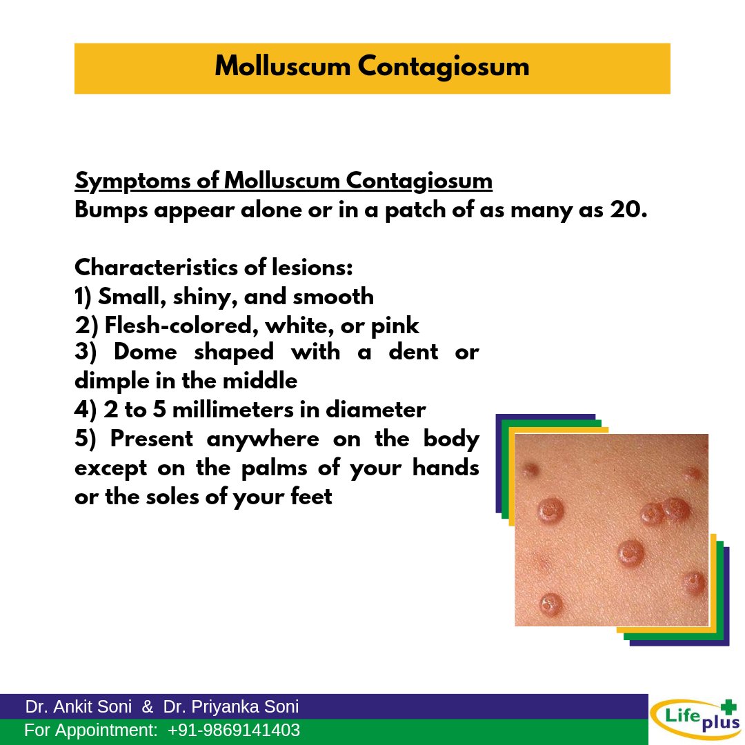 ahsoni1986's tweet photo. Symptoms of Molluscum Contagiosum

 #molluscum #molluscumcontagiosum #eruption #lifeplushomoeopathyclinic #molluscumtreatment https://t.co/0mTpG3yFAA