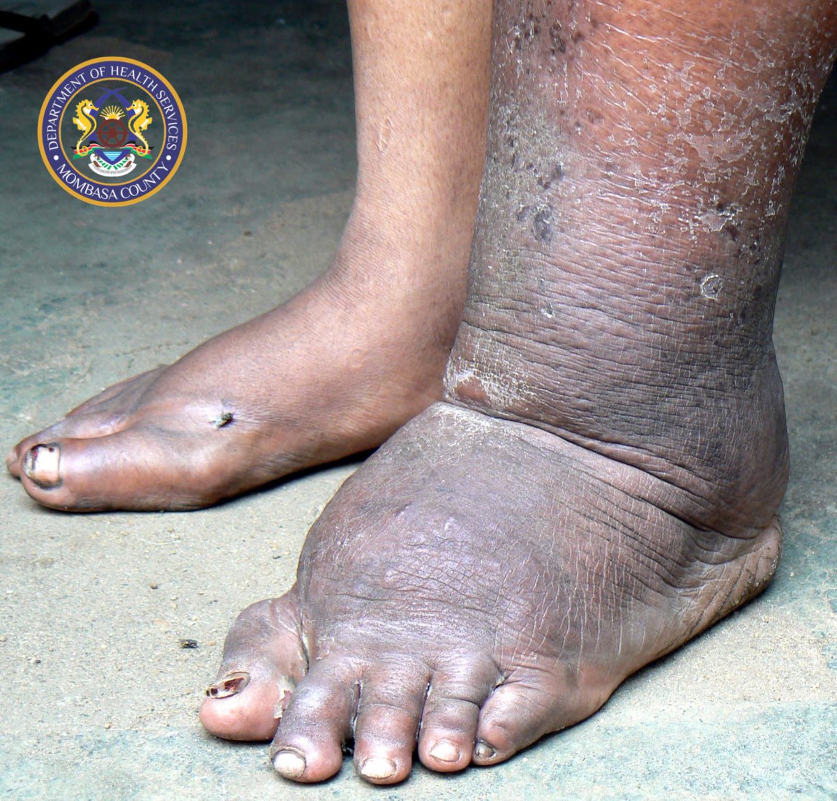 DoHMombasa's tweet photo. The Department of Health with support from the @MOH_Kenya and partners will do a mass drug administration against lymphatic filariasis (Matende) from 30th January to 4th February 2024. 

Community drug distributors will move door to door to give medicine to the public in https://t.co/6ETZsnYP9y