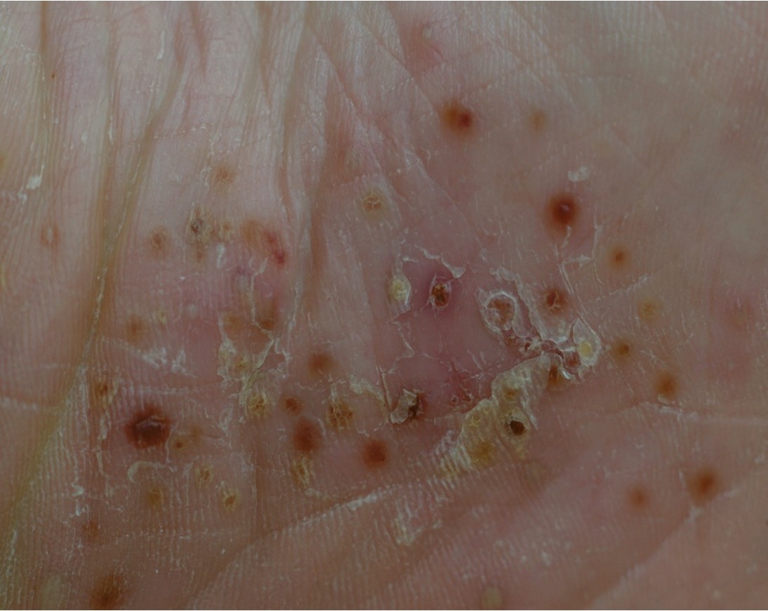 Do you suffer from Palmoplantar Pustulosis?

@BWHDermatology is looking for patients with PPP that has not responded to previous treatments to participate in a paid clinical trial.  All participants will receive the study medication.

Learn more here: bit.ly/484vI67