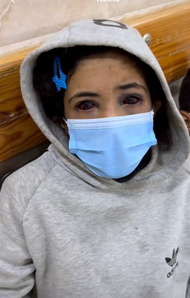 Bu çocuğu hatırlıyor musunuz? ismi Emine.

Babası ve kız kardeşi bir tank tarafından ezilerek şehit olmuşlardı kendisi de yaralanmıştı.
acil bir şekilde tedavi olmak üzere Gazze'den çıkması gerekiyor yoksa gözlerini kaybedebilir!!

Lütfen hepimiz Emine'nin sesi olalım..