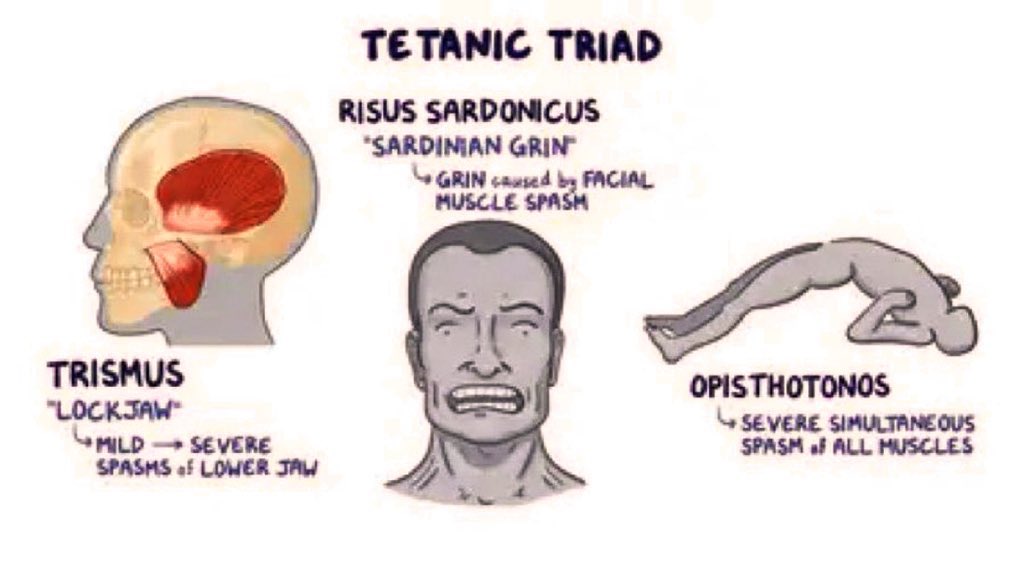 docxusofficial's tweet photo. Opisthotonus Position - Tetanus

Tetanus is a bacterial infection caused by the bacterium Clostridium tetani. 

The bacteria release a toxin called tetanospasmin, which affects the nervous system and leads to muscle stiffness and spasms.

Pathogenesis:

Tetanus occurs when the bacterium enters the body through a wound, such as a deep puncture wound or a contaminated injury. 

The bacteria produce tetanospasmin, which binds to nerve endings and travels to the central nervous system. 

It blocks the release of inhibitory neurotransmitters, leading to excessive muscle contractions and spasms.

Clinical Features:

- The opisthotonus position, where the patient's back is arched and the head is thrown back, is a classic sign of tetanus. 

- Other symptoms may include muscle stiffness and spasms, particularly in the jaw (lockjaw), neck, and abdomen. 

- Risus Sardonicus aka Sardinian Grin - caused by facial muscle spasm

- Patients may also experience difficulty swallowing, fever, sweating, and high blood pressure.

Treatment:

The treatment of tetanus involves a combination of supportive care and administration of specific medications. 

The patient should be placed in a quiet and dark environment to minimize stimuli that can trigger muscle spasms. 

Wound care is crucial to prevent further bacterial growth, and antibiotics may be prescribed to eliminate the bacteria. 

Tetanus immunoglobulin is administered to neutralize the toxin, and tetanus toxoid vaccine is given to boost immunity. 

Muscle relaxants and sedatives may be used to control muscle spasms.

FAQS:

1. Can tetanus be prevented? Yes, tetanus can be prevented through vaccination. Routine immunization with the tetanus toxoid vaccine is recommended.

2. How long does it take for tetanus symptoms to appear after infection? The incubation period for tetanus can range from a few days to several weeks. It typically takes around 7 to 10 days for symptoms to appear.

3. Is tetanus contagious? No, tetanus is not contagious. It is caused by the introduction of the bacteria into the body through a wound.

4. Can tetanus be fatal? Yes, tetanus can be a life-threatening condition, especially if not treated promptly. Complications such as respiratory failure and cardiac arrest can occur.

5. How long does it take to recover from tetanus? The recovery from tetanus depends on the severity of the infection and the promptness of treatment. It can take several weeks to months for a patient to fully recover.

Try - https://t.co/3XKwhCuWoV