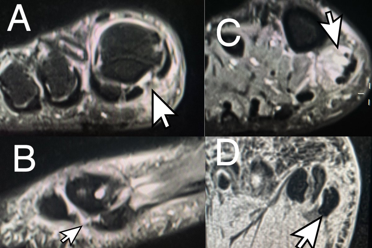 Turf toe injury grade 3

✅Edema and discontinuity (A,B) present along the plantar plate in the region of the medial sesamoid phalangeal ligament.
✅Edema compatible with a muscle strain (C) within the abductor hallucis
✅ Proximal migration of the medial sesamoid (D)

#mskrad