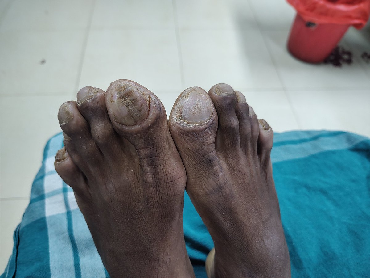 Patient Aged 19 presented with  B/L Clubbing, Long slender Fingers. Vitals Stable. No other Clinical / systemic findings. 
What are the differential diagnosis? How to proceed further? #ClinicalMedicine #InterestingCases