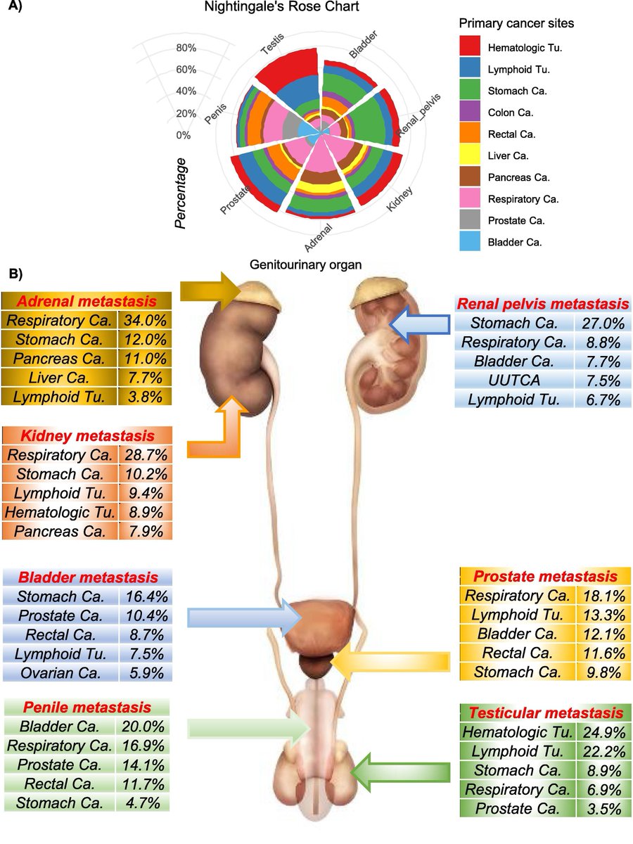 Metastatic Sites in Rare Genitourinary Malignancies and Primary Cancer Sites in Genitourinary Organ Metastases: A Secondary Analysis Using the Japanese Pathological Autopsy Registry Database by Tomohiko Hara et al buff.ly/3HtU8Kt #UroSoMe #Medtwitter