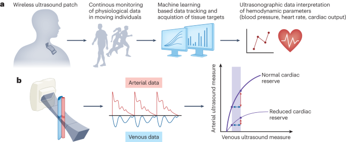 NatureBiotech's tweet photo. An integrated wearable and wireless ultrasound device enables the continuous monitoring of physiological information from tissues in moving individuals #NBTNV https://t.co/kY65071S4G 
https://t.co/ofGKzlF3XP https://t.co/KIQ38HJih6