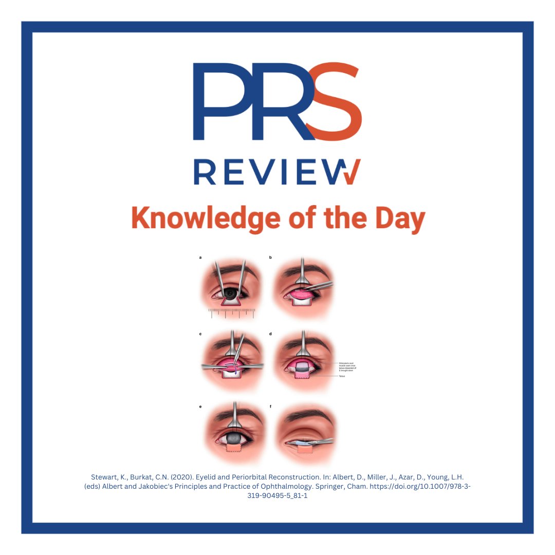 Hughes flap for eyelid reconstruction

#prsreview #hughesflap #eyelidreconstruction #mohsurgery #oculoplastics #ophthalmology #craniofacialsurgery #facialplastics #plasticsurgery #reconstructivesurgery #surgicaleducation #medicaleducation #meded #plasticsurgeon #surgery