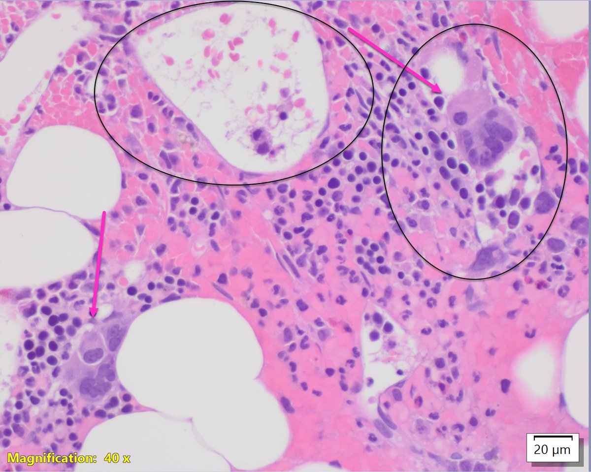 Dilated sinusoids (circles) and intrasinusoidal megakaryopoiesis (arrows)… pretty good sign of advanced BM fibrosis
commonly seen in myeloproliferative neoplasms  #MPNsm with firbrosis (esp. PMF) but not specific ❌
#hemepath