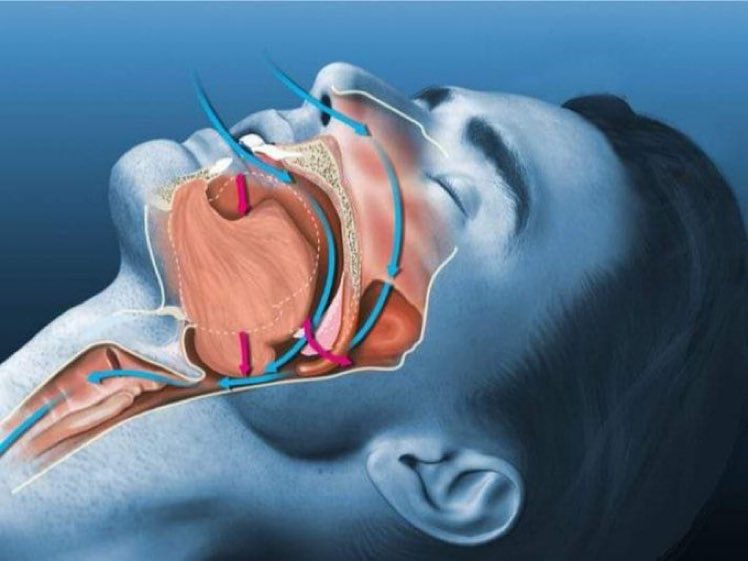 🚨 الشخير ....
لمن يعانون من الشخير أثناء النوم اليكم طرق مفيدة للتخلص من الشخير 👌🏻 

نصيحة إذا مشغول فضلها وارجع لها بعدين ♥