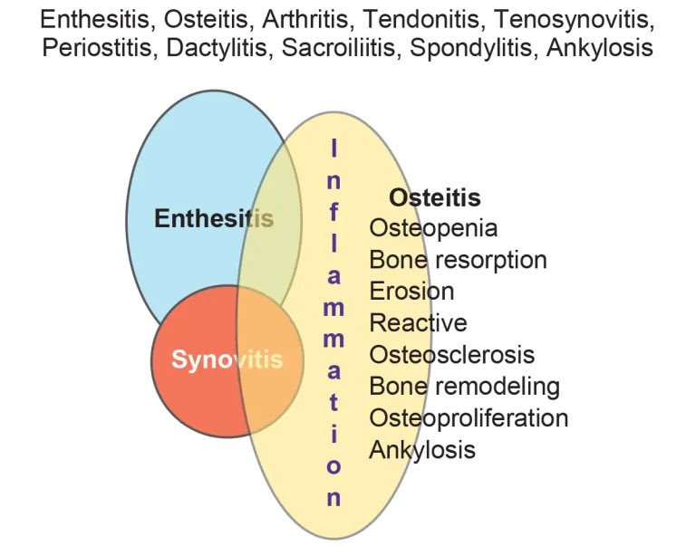 🔺Synovio-Entheseal Complex and Resultant Features of #SpA.

#enthesitis #synovitis #tenosynovitis #erosion #sacroilitis #spondylitis #BMO #osteitis #tendonitis #periostitis #AxSpA