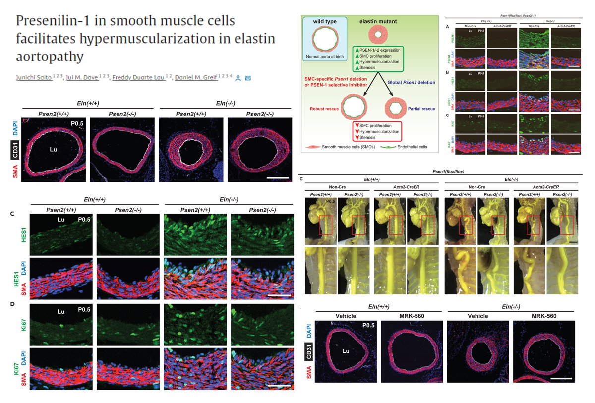 Hao Yin (@haoyin20) on Twitter photo #SmoothMuscleCell Presenilin-Notch hyperactivity mediates Aortic Multilayering hypermuscularization upon Elastin deficiency
Eln-/- or +/-🐭
Eln+/-👤#SupraValvularAorticStenosis
<a href="/GreifLab/">DanielGreifLab</a> <a href="/iScience_CP/">iScience journal</a> 2024
sciencedirect.com/science/articl…
How elastin insufficiency⏫Presenilin in SMCs? #SmoothMuscleCell Presenilin-Notch hyperactivity mediates Aortic Multilayering hypermuscularization upon Elastin deficiency
Eln-/- or +/-🐭
Eln+/-👤#SupraValvularAorticStenosis
<a href="/GreifLab/">DanielGreifLab</a> <a href="/iScience_CP/">iScience journal</a> 2024
sciencedirect.com/science/articl…
How elastin insufficiency⏫Presenilin in SMCs?